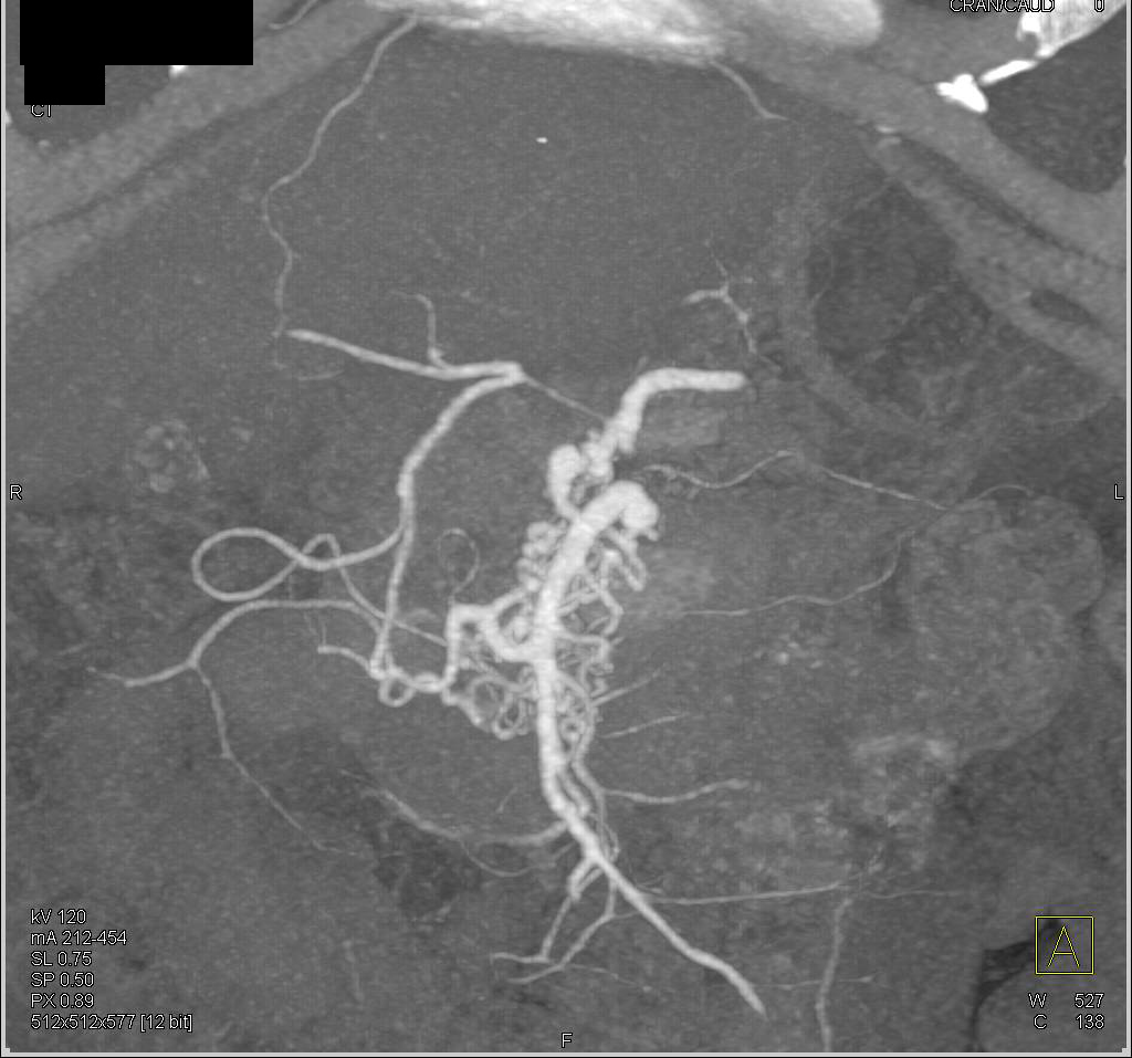 Multiple Collateral Vessels Around the SMA - CTisus CT Scan