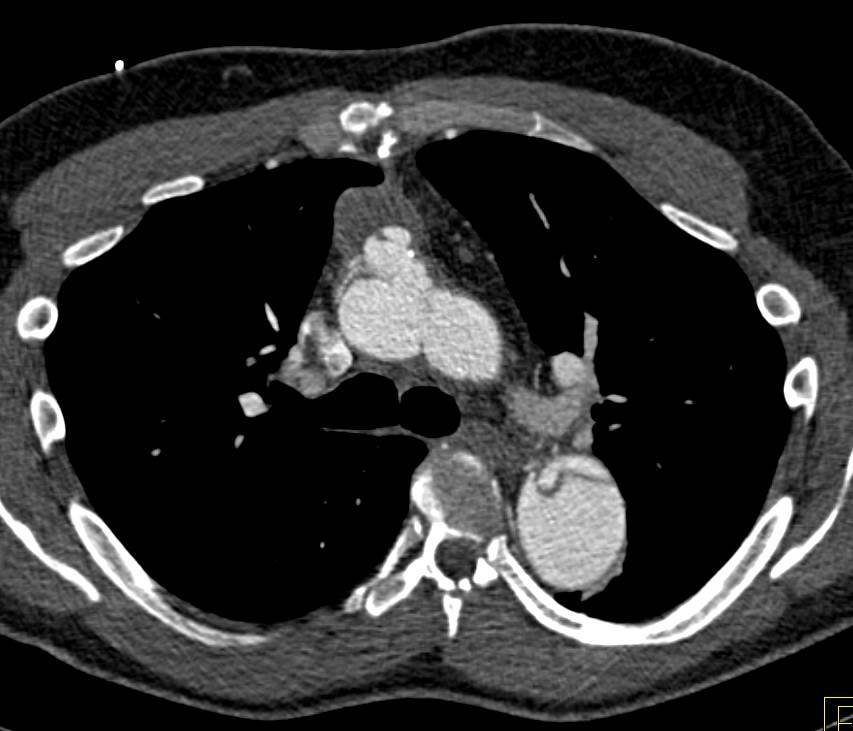 Complex type A Dissection s/p Aortic Valve Replacement (AVR) - CTisus CT Scan