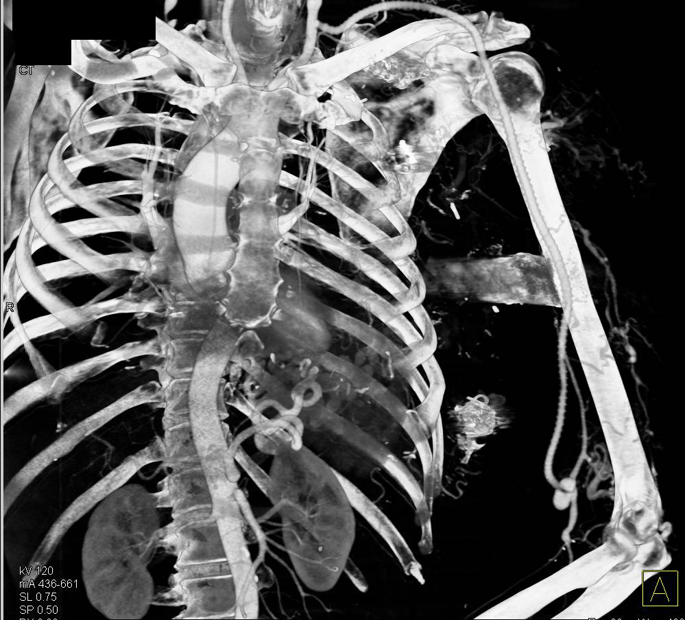 Graft from Subclavian Artery to Brachial Artery - CTisus CT Scan