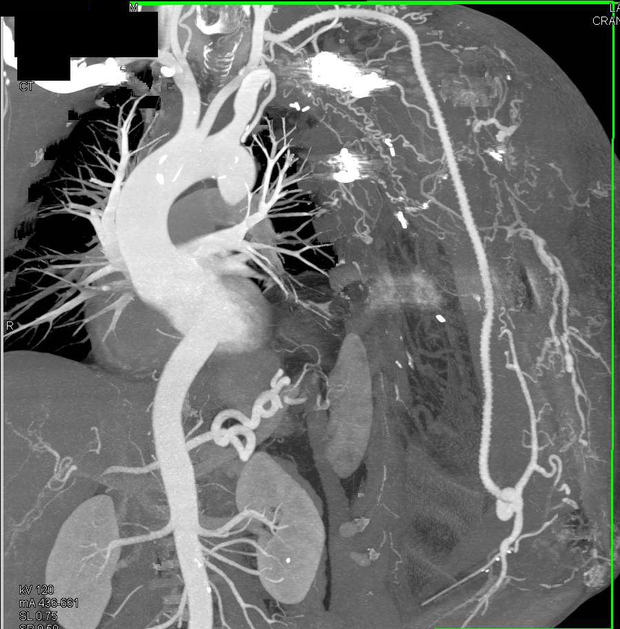 Graft from Left Subclavian Artery to Distal Brachial Artery - CTisus CT Scan