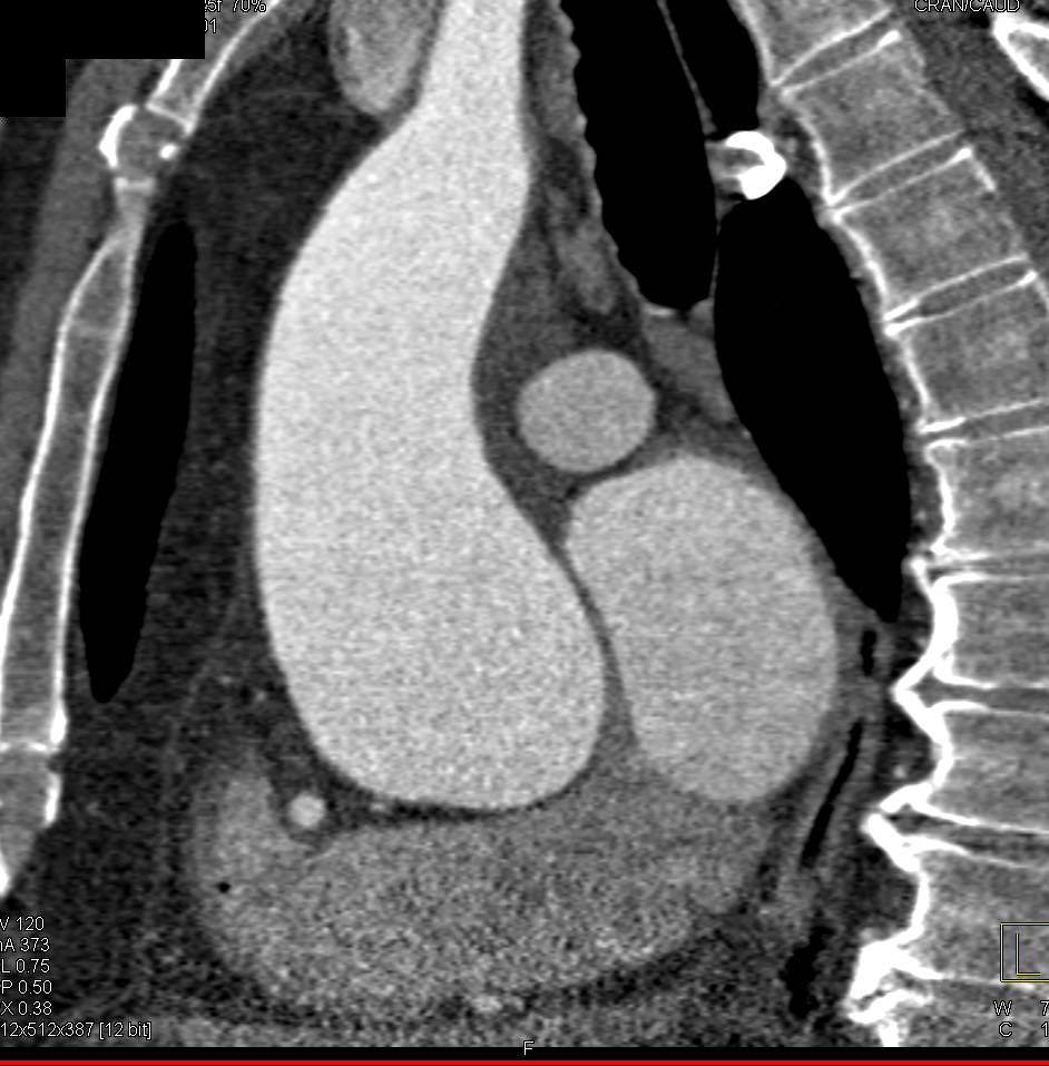 Marfan Syndrome with Dilated Sinus of Valsalva - CTisus CT Scan