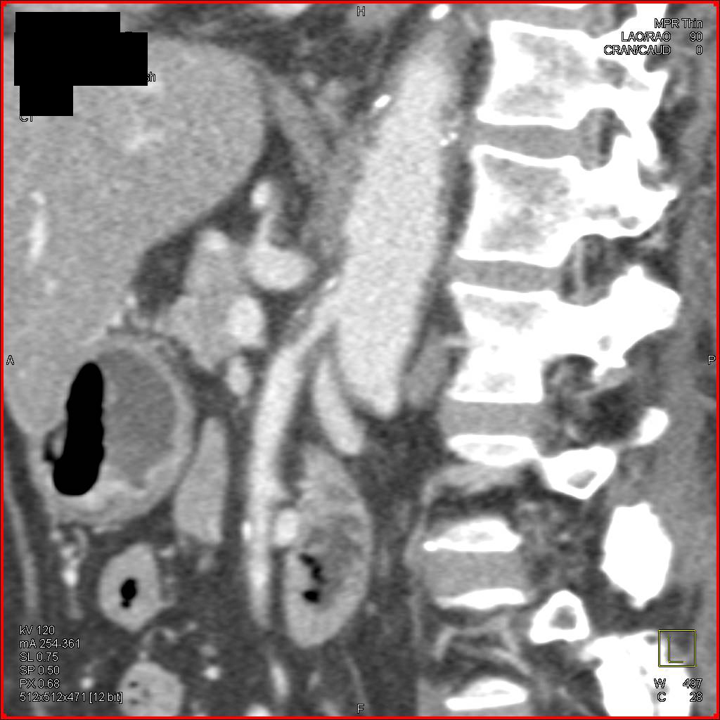 Plaque Causes Occlusion of Proximal Celiac Artery and Marked Narrowing of the SMA - CTisus CT Scan