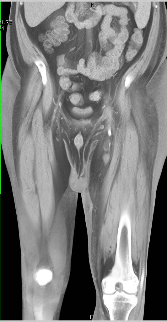 CTA Runoff with Multiple Grafts and Stents - CTisus CT Scan