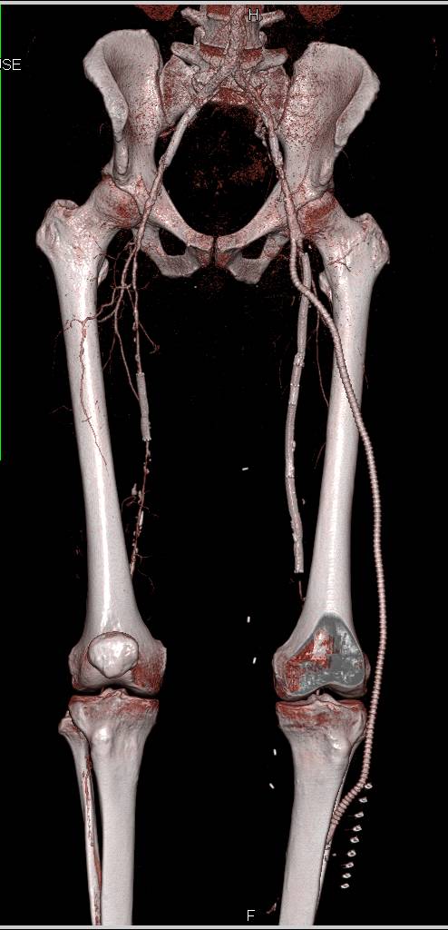 CTA Runoff with Multiple Stenosis is Superficial Femoral Artery (SFA) and Stents and Bypass Grafts in VRT - CTisus CT Scan