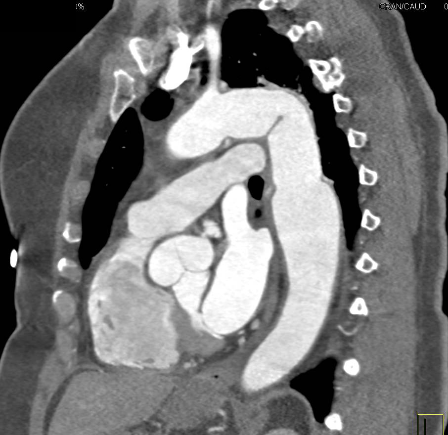 3D Mapping of Aortic Aneurysm in Arch - CTisus CT Scan