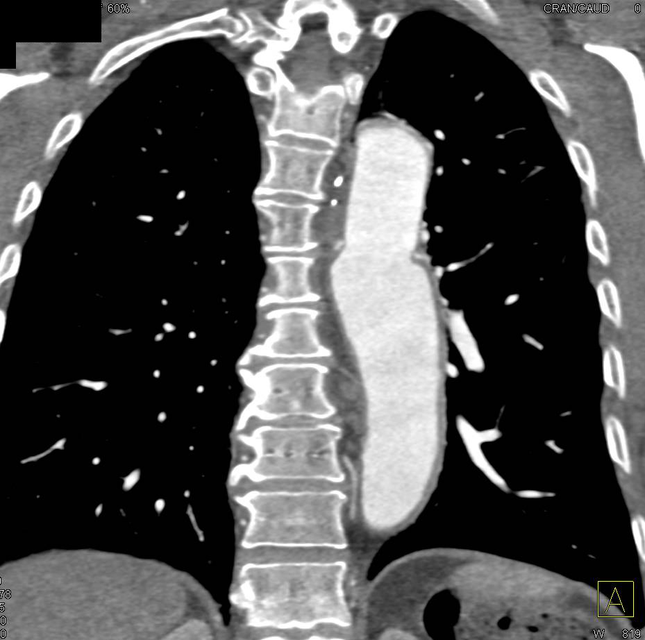 Surgical Repair of Aortic Arch - CTisus CT Scan