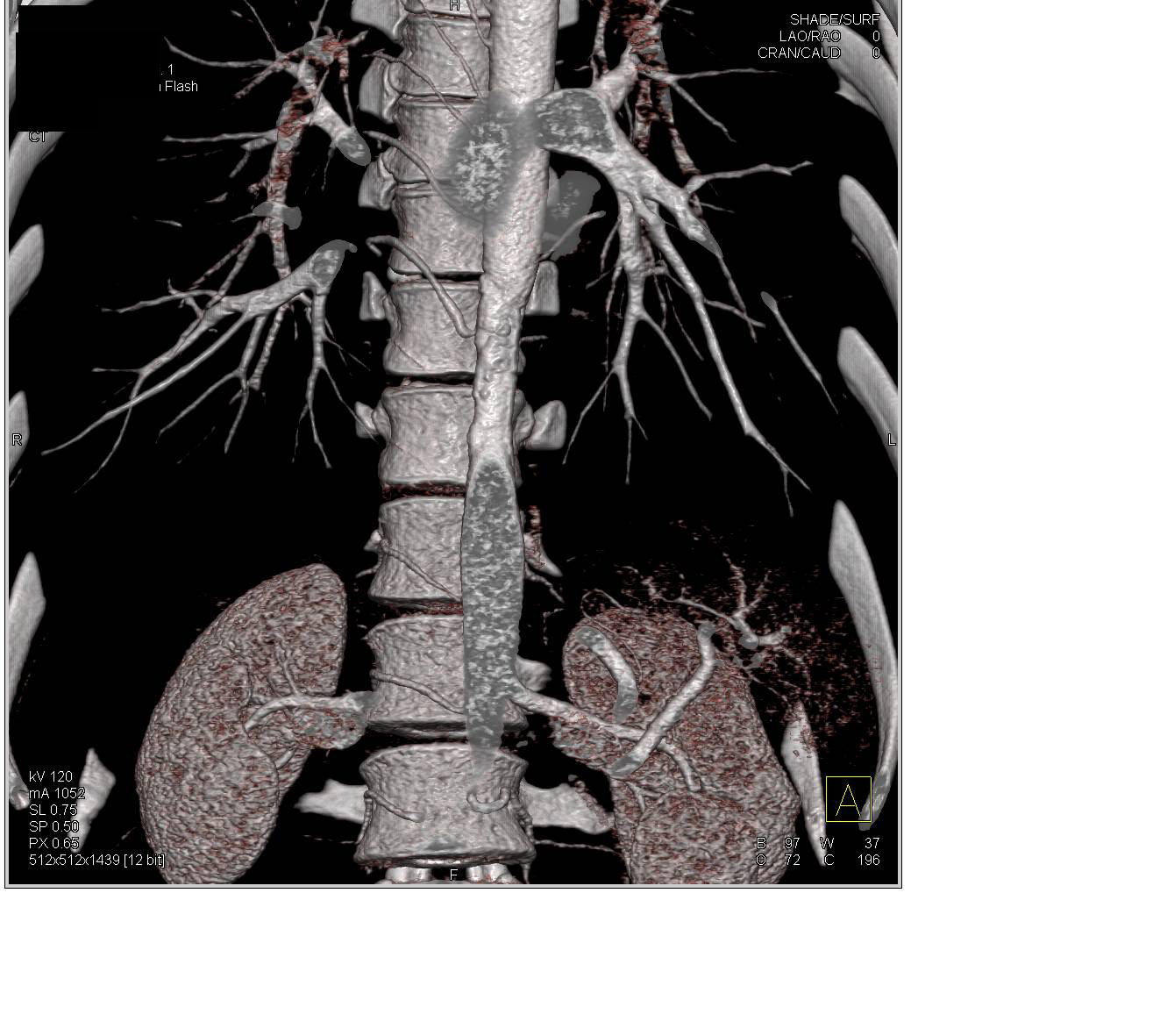 Stenosis of Lower Thoracic Aorta with Unusual Calcifications in 3D - CTisus CT Scan