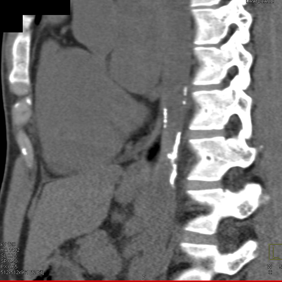 Unusual Vascular Calcifications in the Aorta - CTisus CT Scan