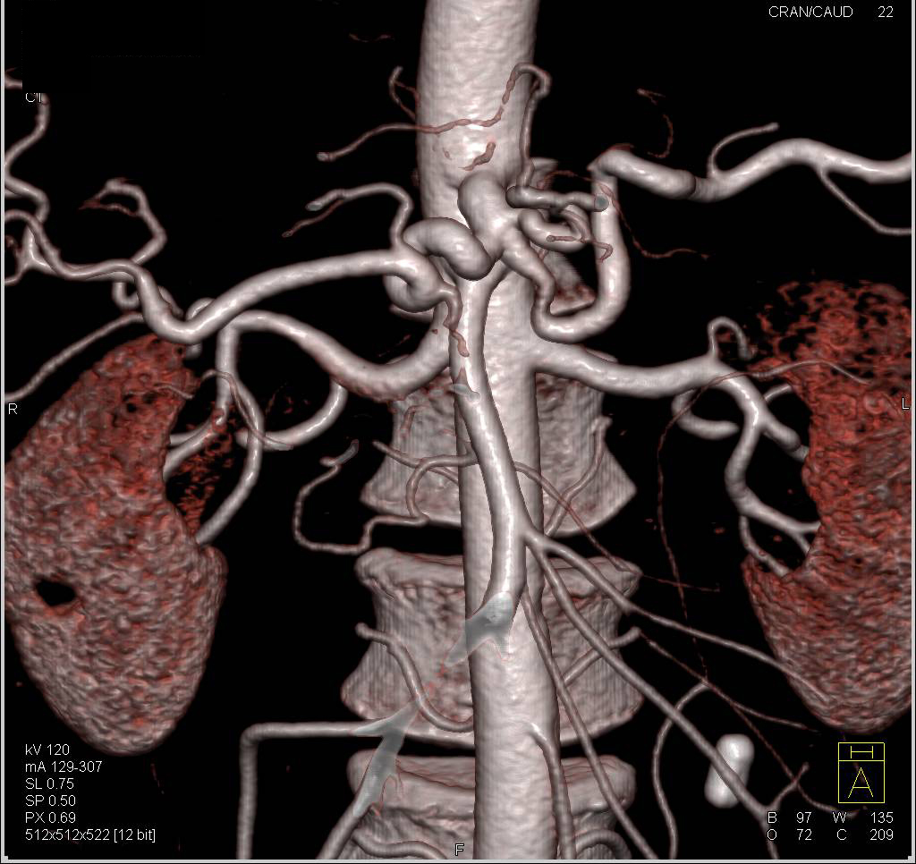 Mesenteric Arcade - CTisus CT Scan