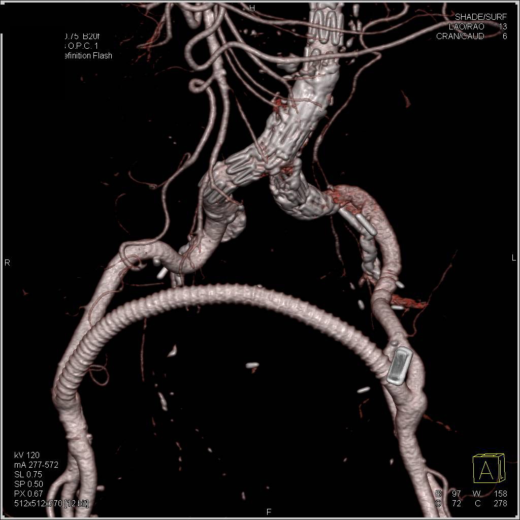 Endovascular Stent and Fem-Fem Bypass - CTisus CT Scan