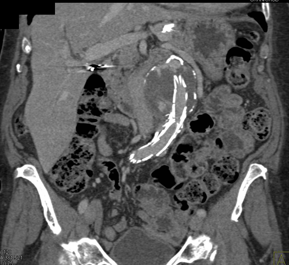 Endovascular Stent with Occluded Left Limb - CTisus CT Scan