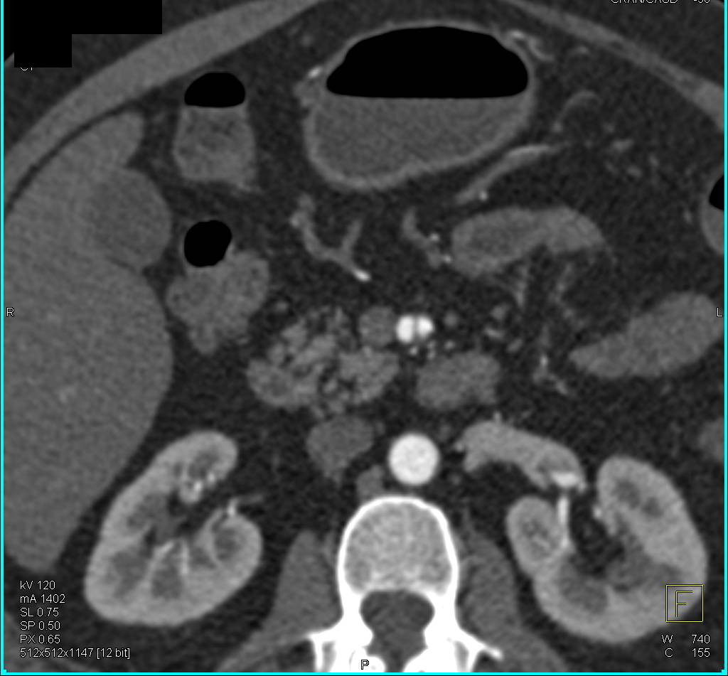 Multiple Dissections Including Superior Mesenteric Artery (SMA) and Left External Iliac Artery - CTisus CT Scan