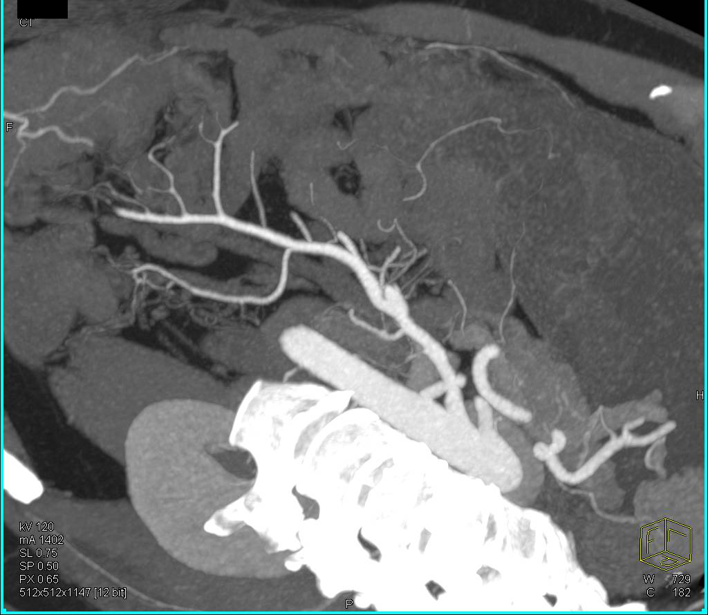 Focal Superior Mesenteric Artery (SMA) Dissection - CTisus CT Scan