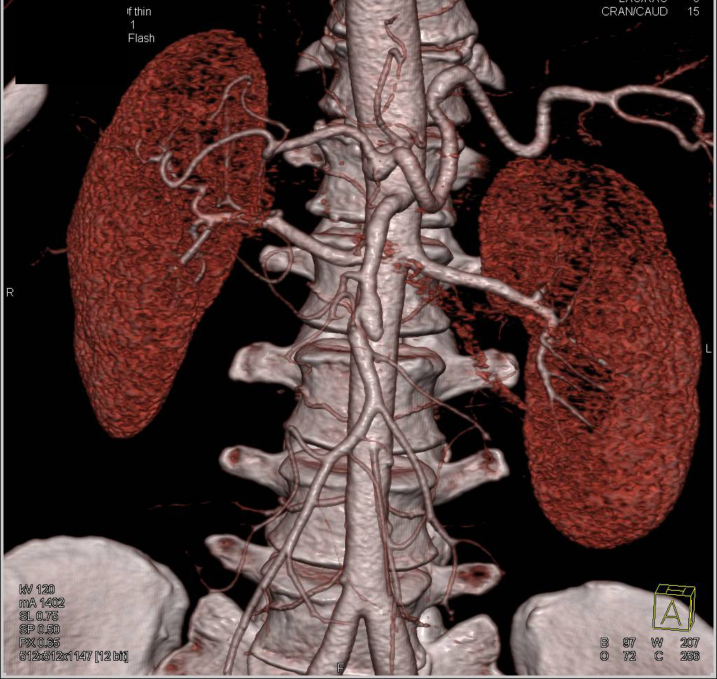 Focal Superior Mesenteric Artery (SMA) Aneurysm - CTisus CT Scan