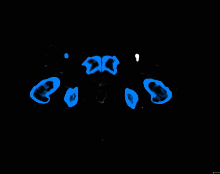 Bone Editing with Peripheral Vascular Disease (PVD) - CTisus CT Scan