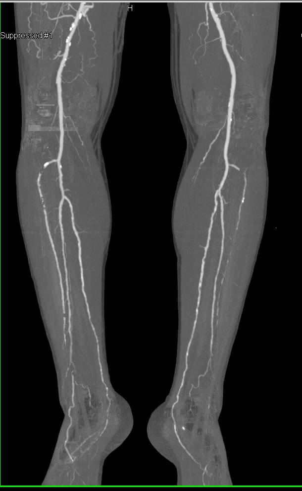 CTA Runoff with Right Superficial Femoral Artery (SFA) with Long Segment Occlusion - CTisus CT Scan