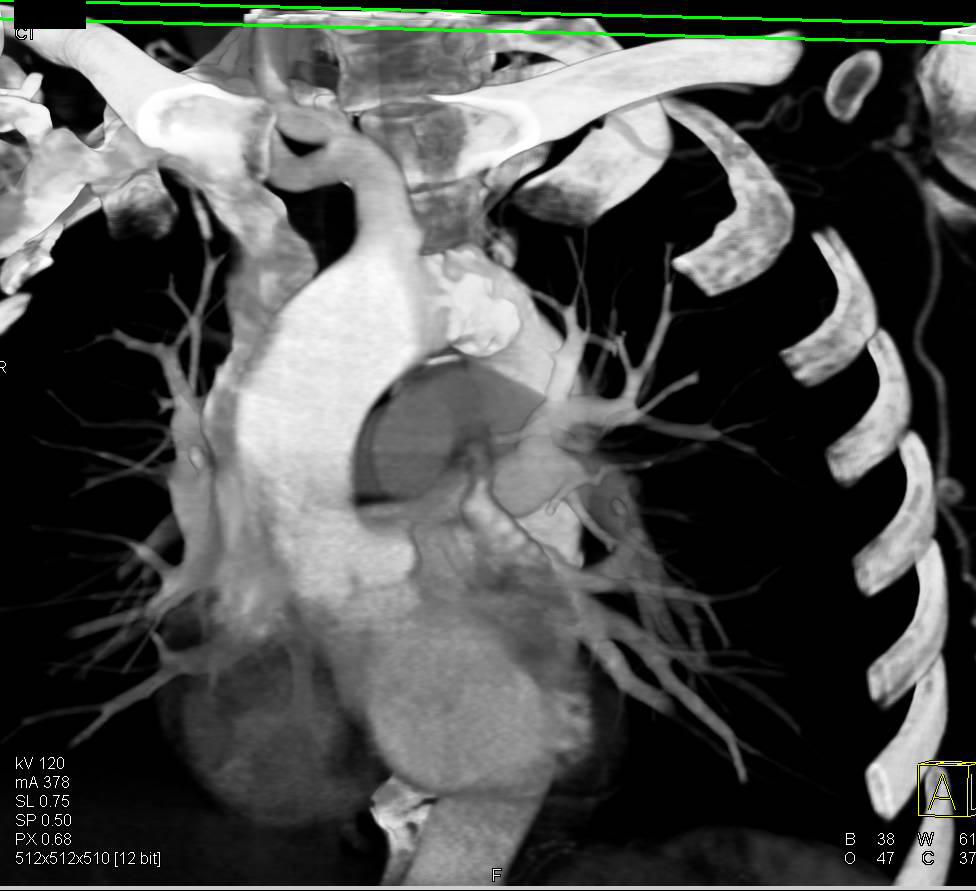 Ulcer Descending Thoracic Aorta - CTisus CT Scan