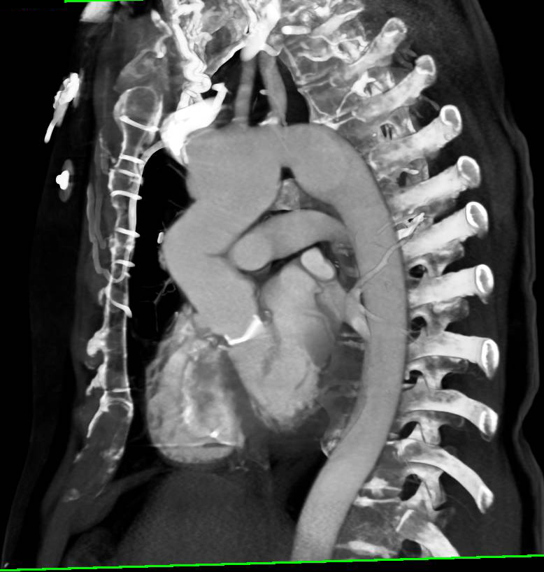 Aortic Aneurysm Repair - CTisus CT Scan