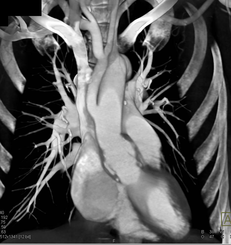 Aortic Repair with Vascular Bypass Grafts and Reimplantation of the Great Vessels - CTisus CT Scan