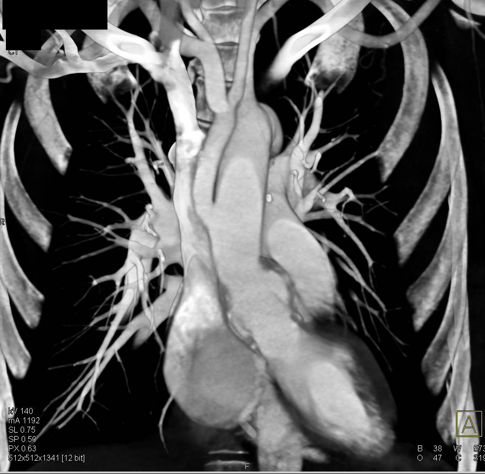 Aortic Aneurysm Repair with Reimplanted Vessels - CTisus CT Scan