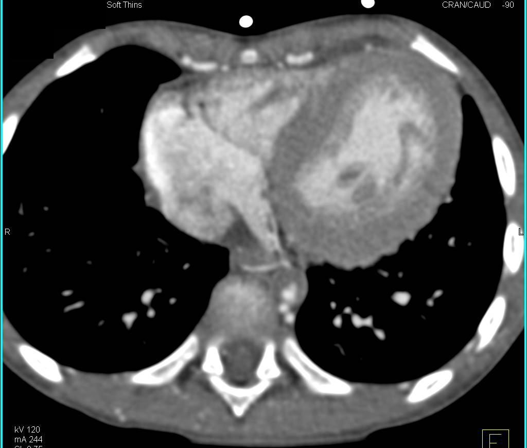 Mid-aortic Syndrome with Stenosis and Collaterals - CTisus CT Scan