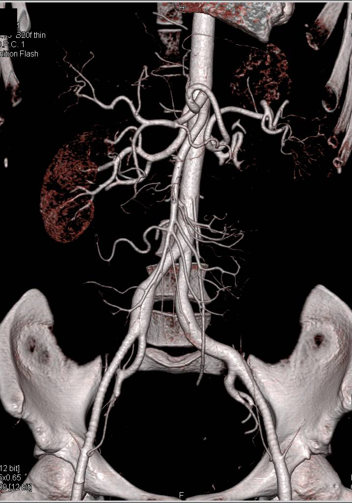 Multiple Aneurysms and Dissections in Ehlers-Danlos Syndrome - CTisus CT Scan