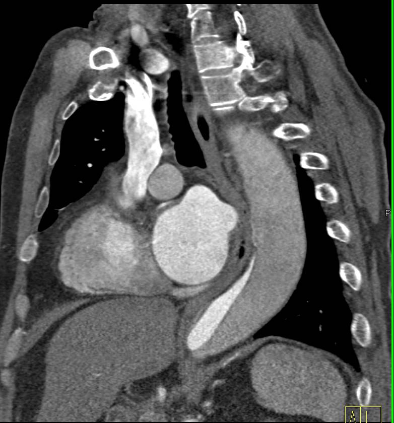 Type A Dissection with 3D Maps and Repair of Ascending Aorta - CTisus CT Scan