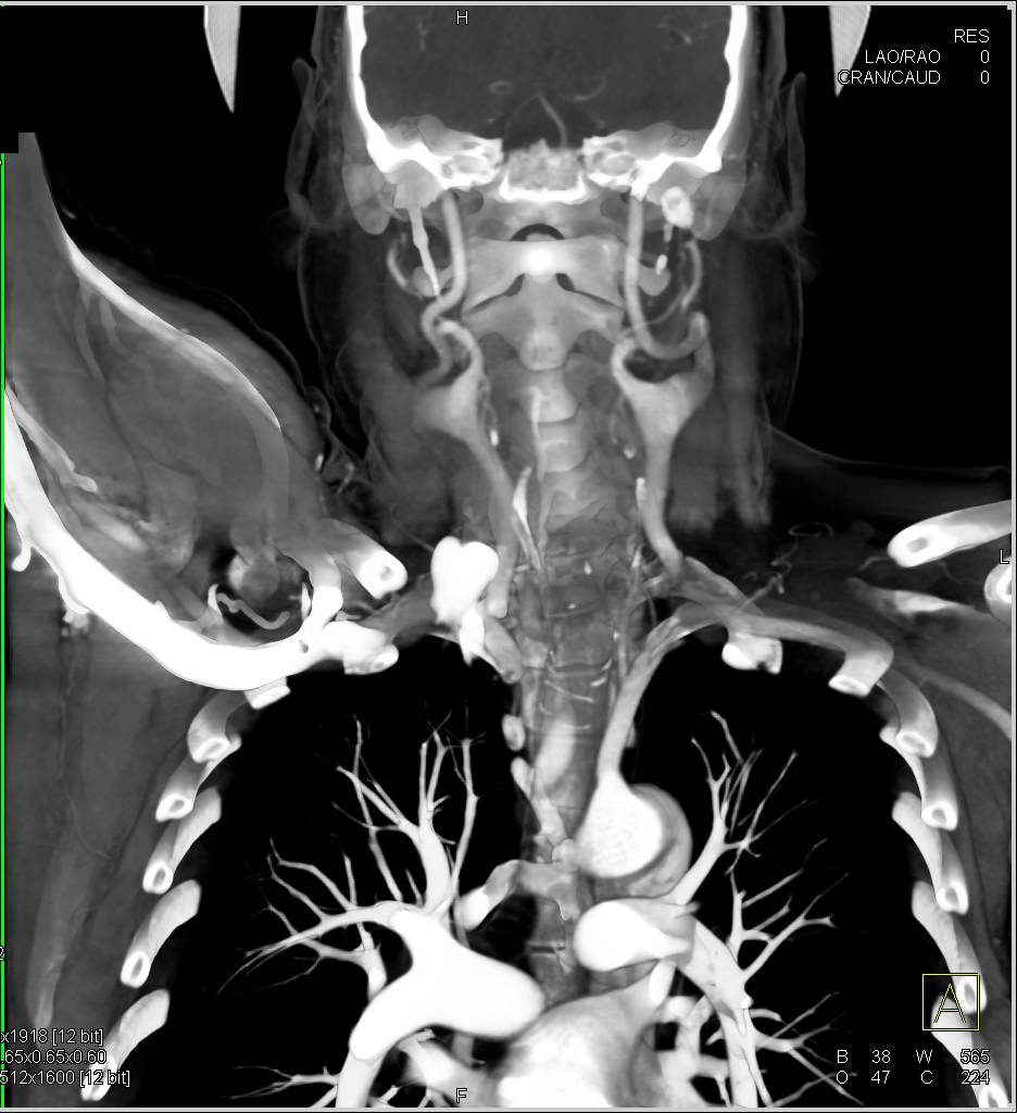 Loeys-Dietz Syndrome with Ectatic Arteries - CTisus CT Scan