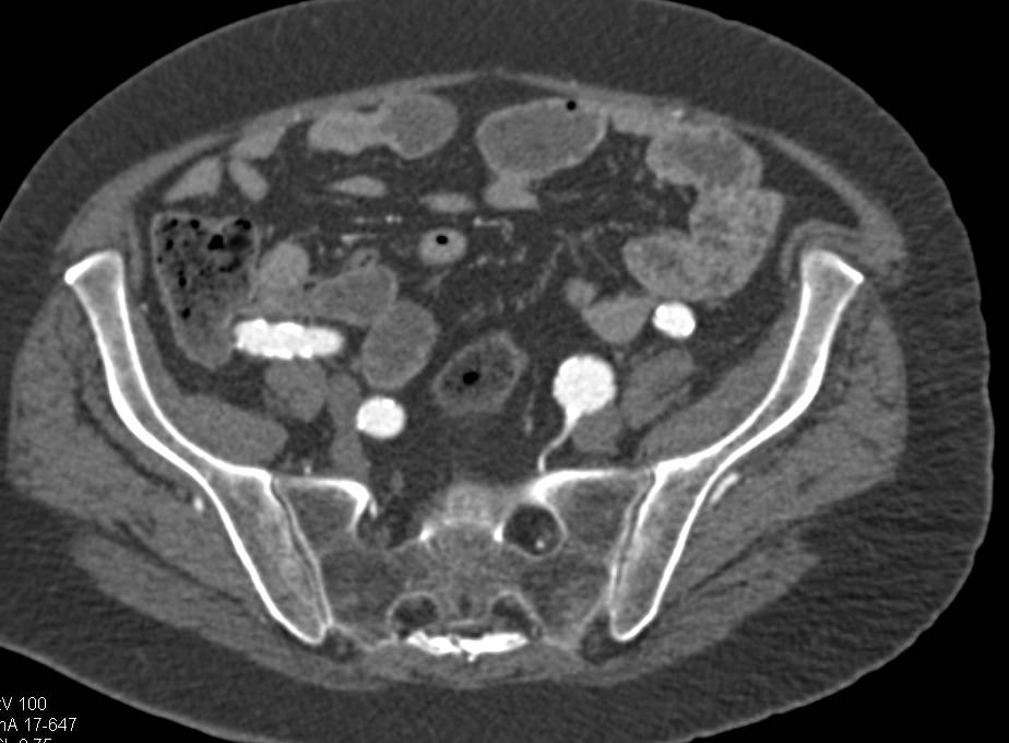 Left Superficial Femoral Artery (SFA) Artery Aneurysm - CTisus CT Scan