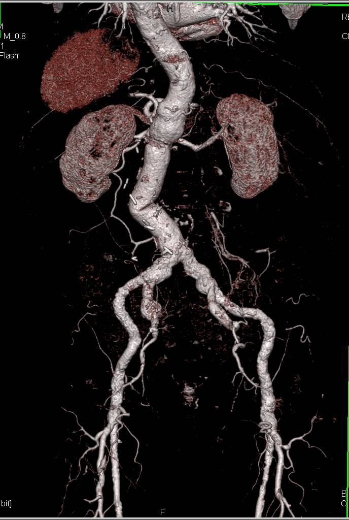 CTA Aorta with Extensive Plaque - CTisus CT Scan