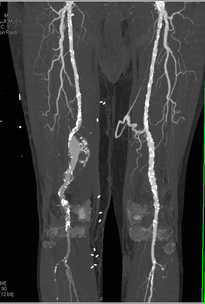 Dual Energy CTA Runoff with Peripheral Vascular Disease - CTisus CT Scan