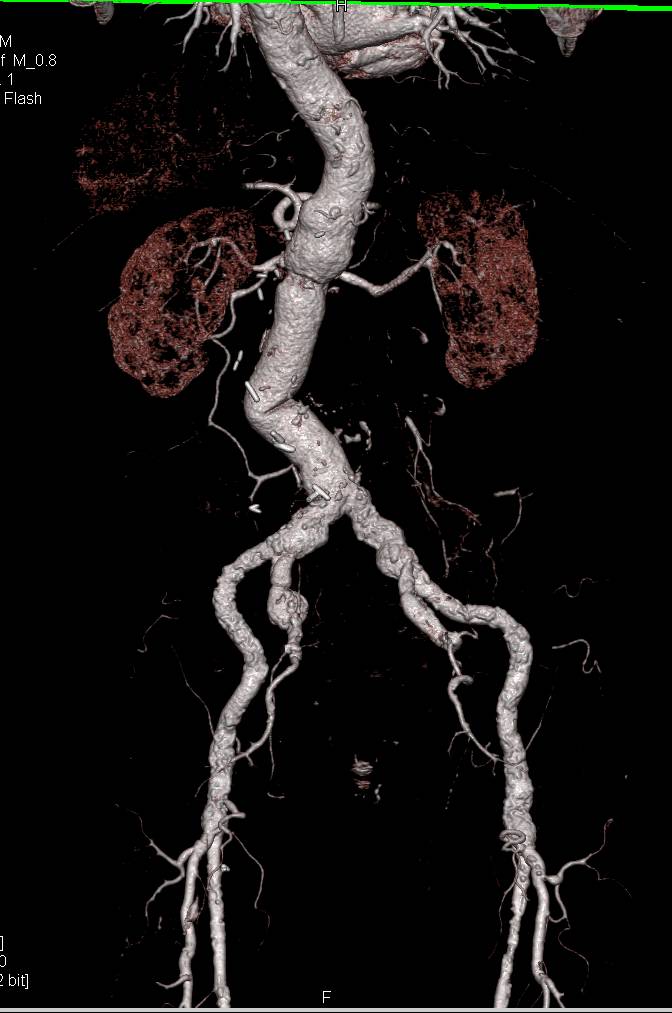 Dual Energy CTA with Peripheral Vascular Disease - CTisus CT Scan