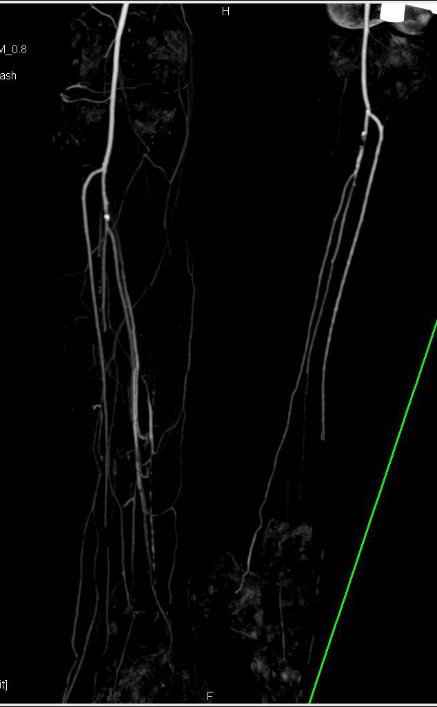 CTA Runoff with Mild Peripheral Vascular Disease (PVD) - CTisus CT Scan