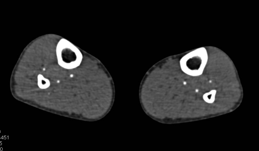 CTA Runoff with Minimal Plaque - CTisus CT Scan