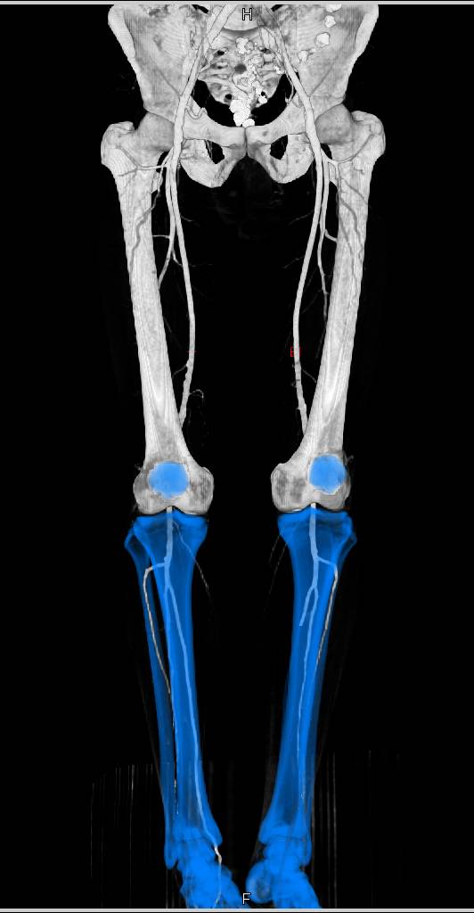 Runoff CTA with Peripheral Vascular Disease - CTisus CT Scan