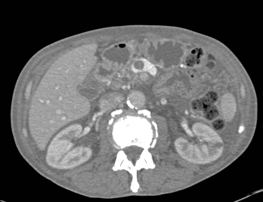 Excellent Example of Clot in the Portal Vein (PV) and Superior Mesenteric Vein (SMV) - CTisus CT Scan