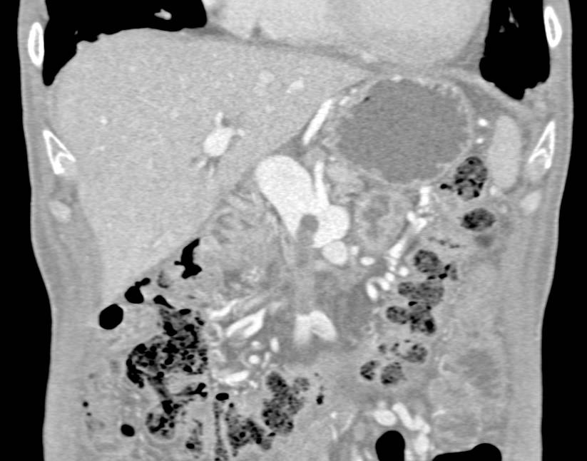 Beautiful 3D Map of Thrombus from Portal Vein to Into Superior Mesenteric Vein (SMV) - CTisus CT Scan