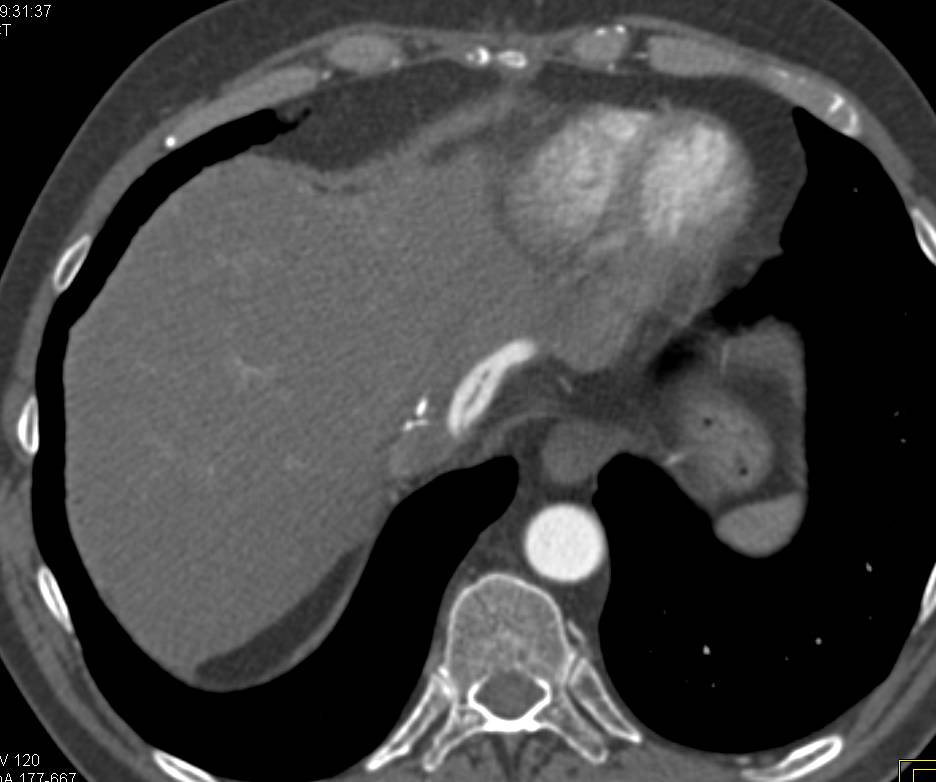 Unusual Vascular Graft at Level of Inferior Vena Cava (IVC) - CTisus CT Scan