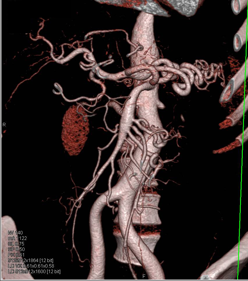Multiple Aneurysms Including Superior Mesenteric Artery (SMA) and Basilar Artery in A Patient with Loeys-Dietz Syndrome - CTisus CT Scan