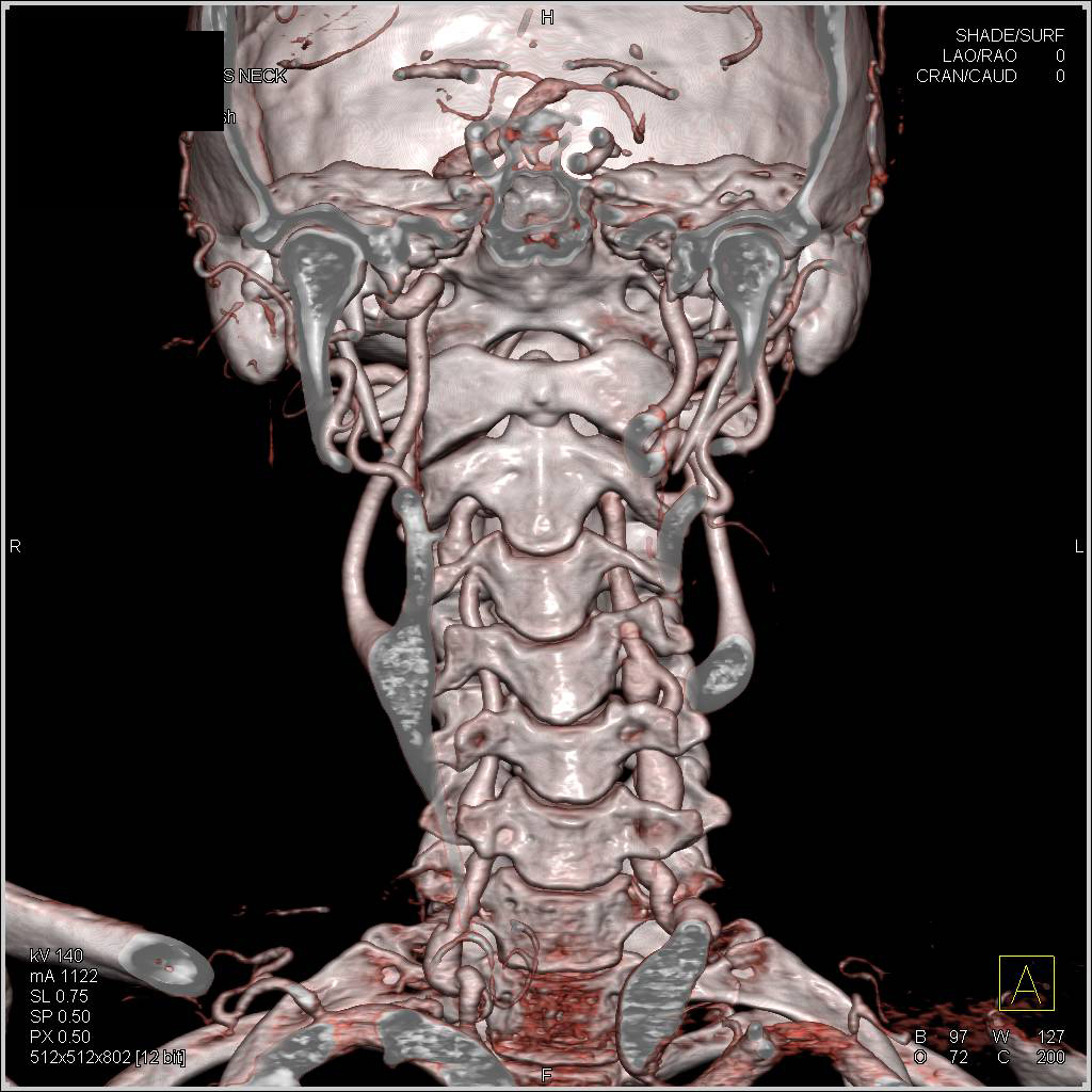 Loeys-Dietz Syndrome with Aneurysm of Vertebral Arteries and Left Subclavian Artery - CTisus CT Scan