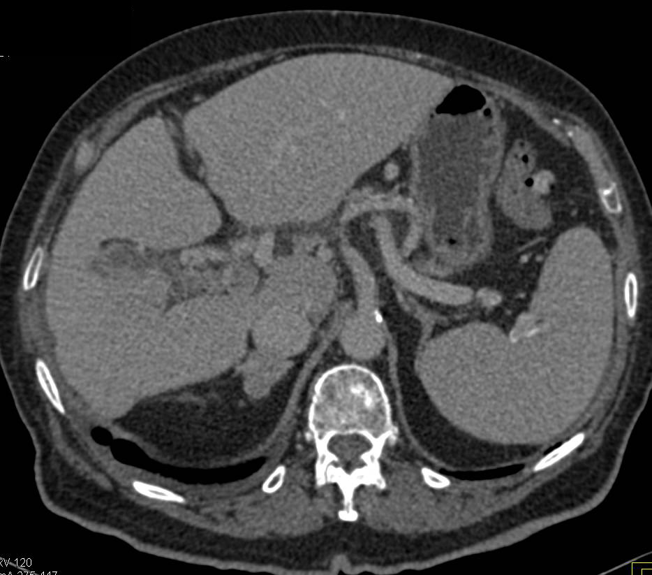 Reflux of IV Contrast into the Inferior Vena Cava (IVC) - CTisus CT Scan