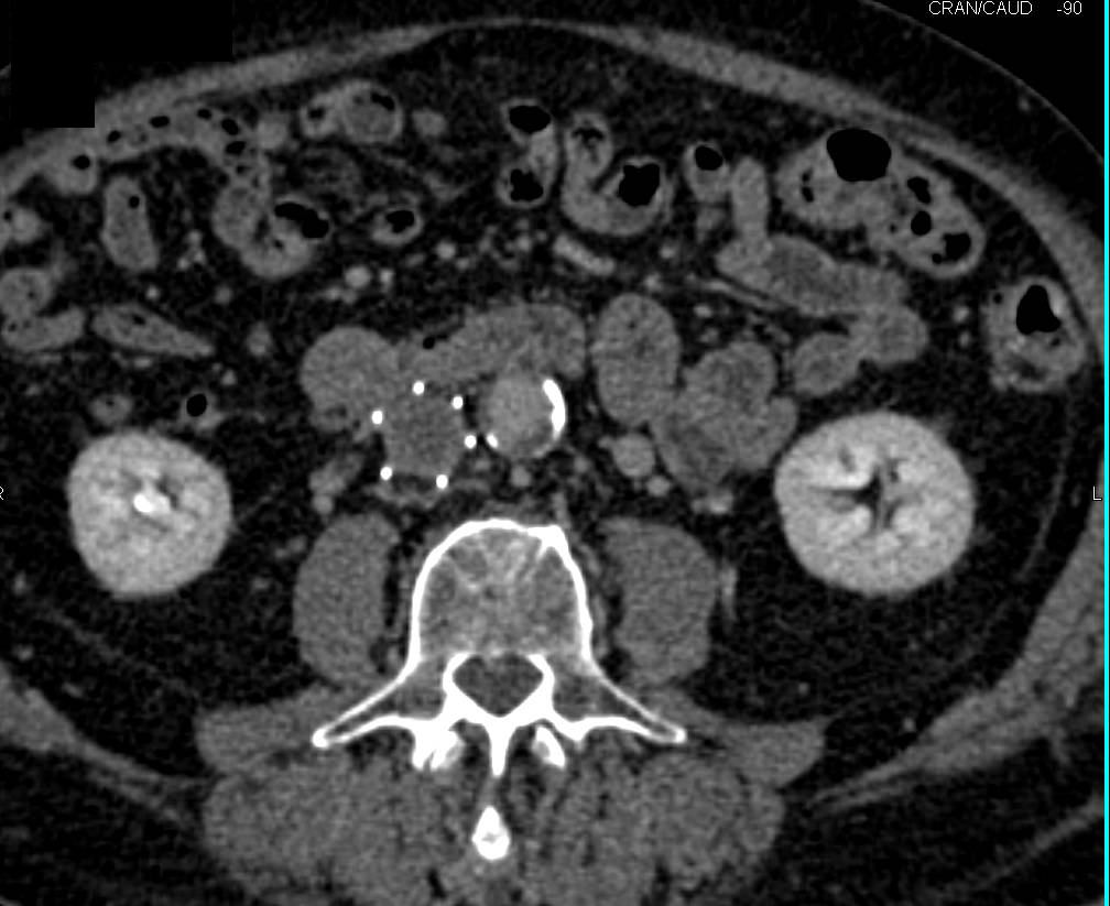 Inferior Vena Cava (IVC), Left Iliac and Left Femoral Vein Clot in Patient with Transitional Cell Cancer (TCC) of the Bladder - CTisus CT Scan