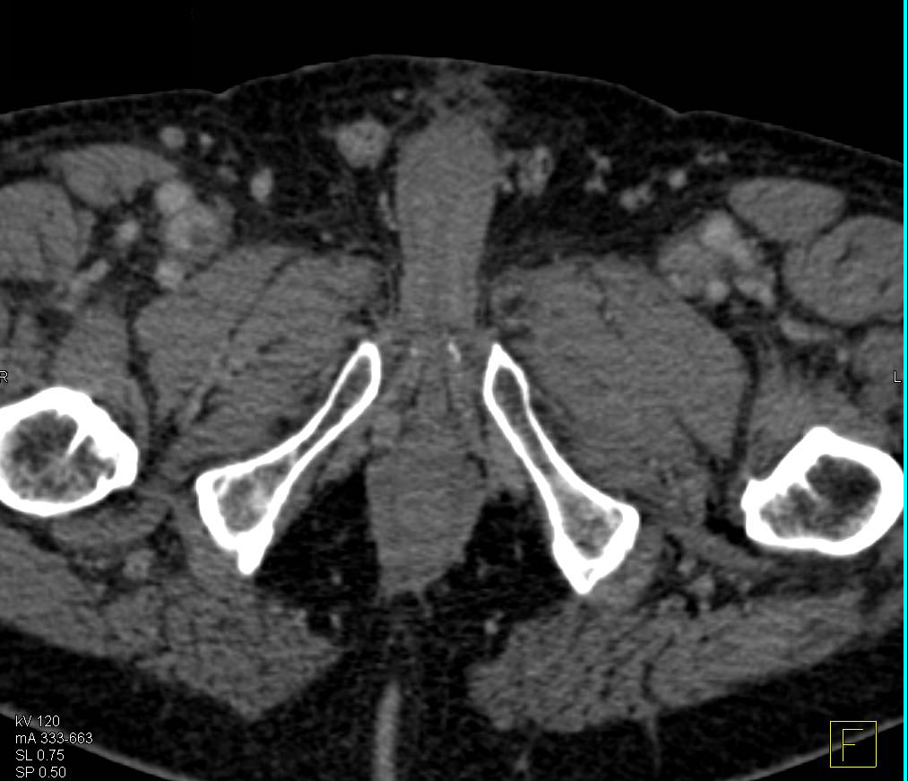 Right Femoral Vein Deep Vein Thrombosis (DVT) - CTisus CT Scan