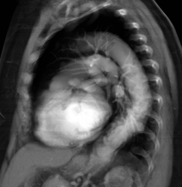 Multiple Ulcers in Descending Thoracic Aorta - CTisus CT Scan