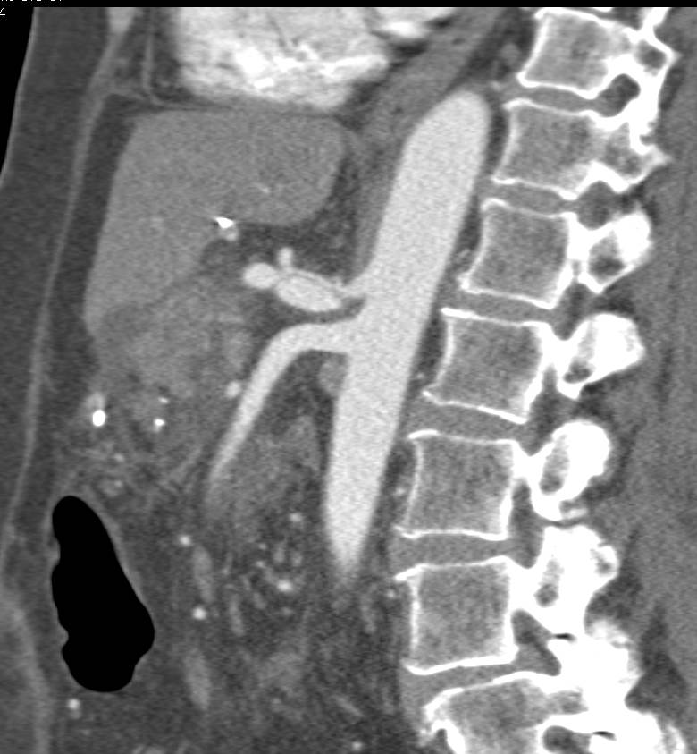 Focal Dissection of the Celiac Artery - CTisus CT Scan