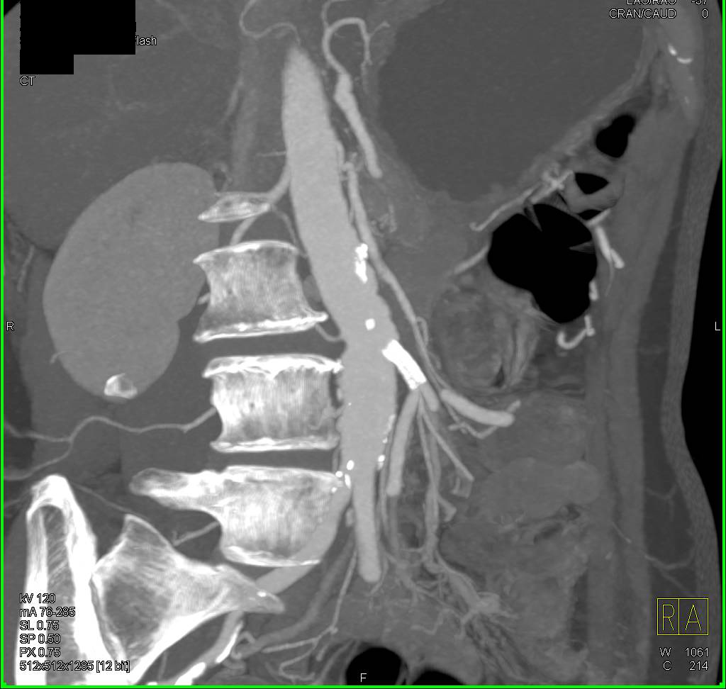 Collateral Pathways due to Celiac Stenosis and Superior Mesenteric ...