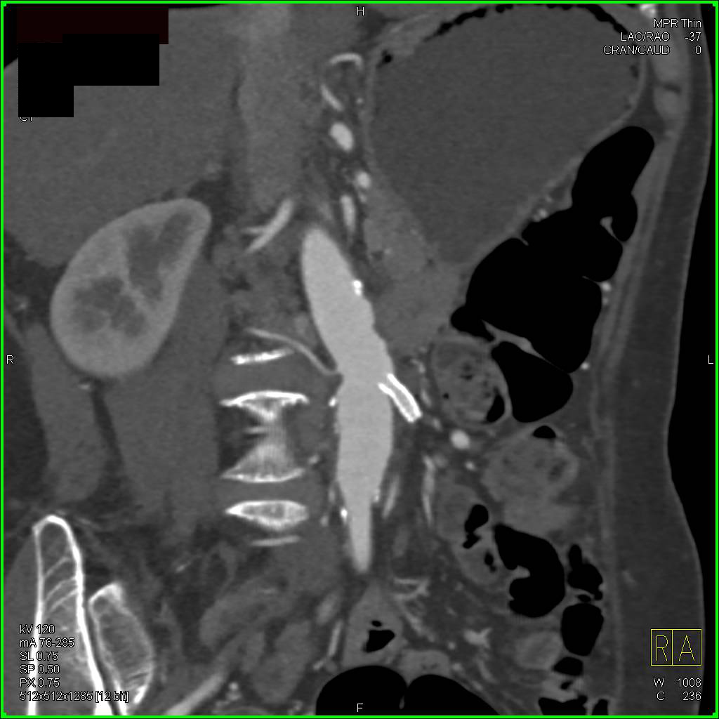 Collateral Pathways due to Celiac Stenosis and Superior Mesenteric Artery (SMA) Occlusion - CTisus CT Scan