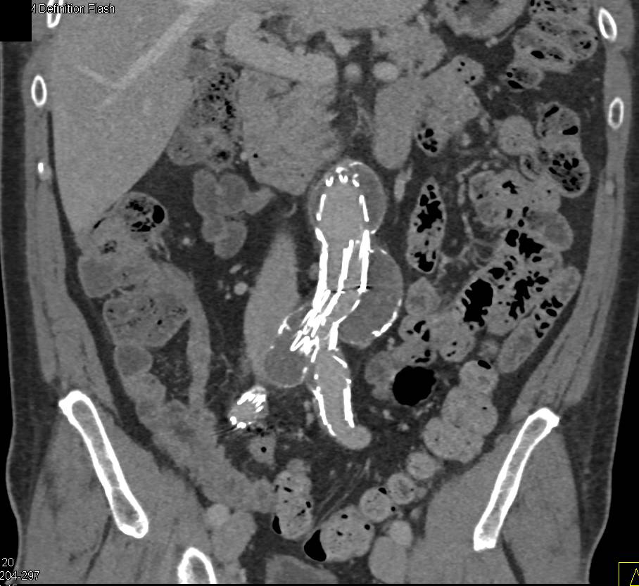 Endovascular Stent Aorta and Stents in the Renal Arteries - CTisus CT Scan