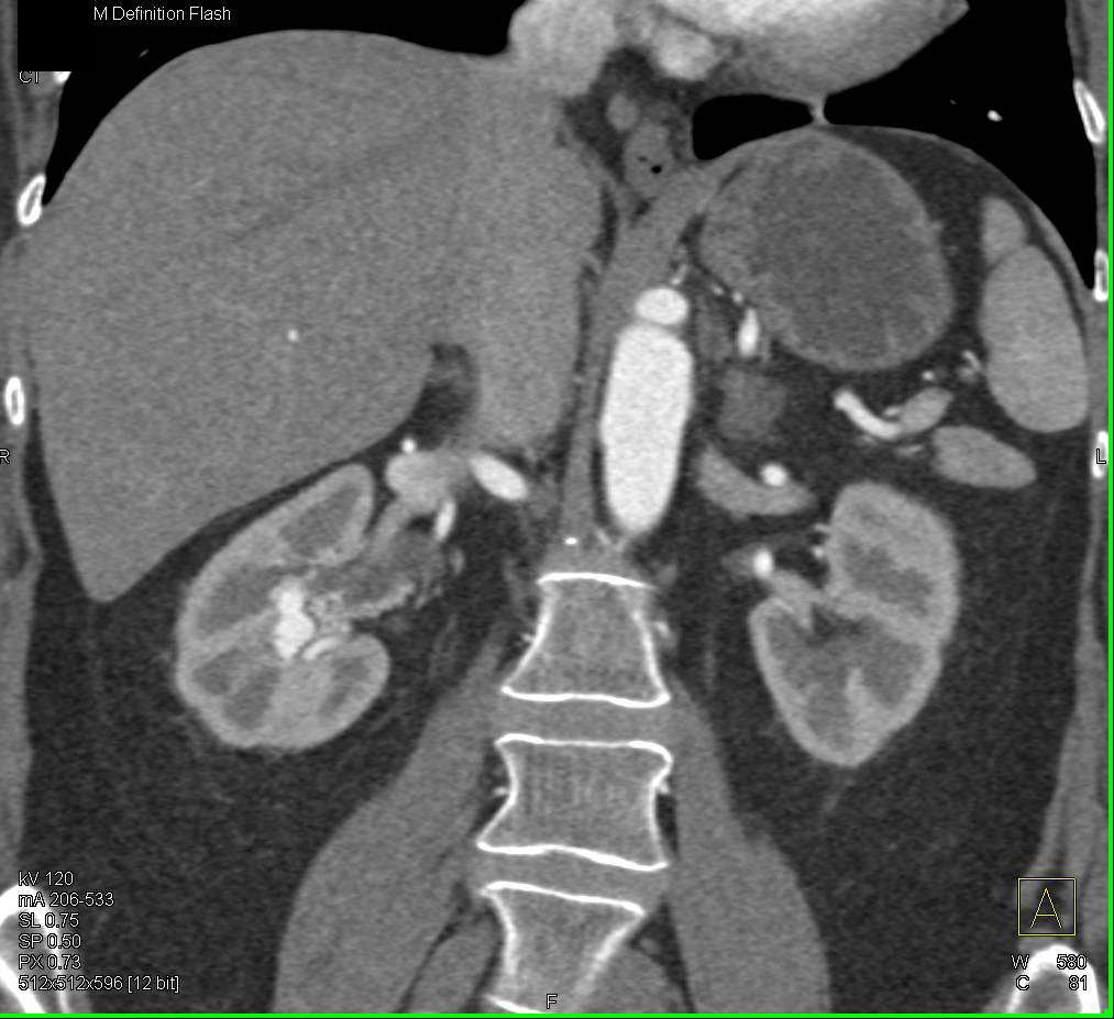 Arteriovenous (AV) Fistulae in the Right Renal Pelvis - CTisus CT Scan