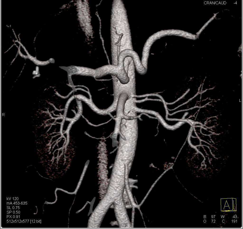 Normal Mesenteric Arcade and Renal Arterial Anatomy - CTisus CT Scan